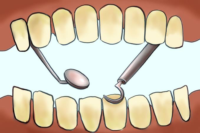 tooth-decay